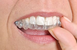 ClearCorrect Invisible Braces for a Beautiful Smile while Straightening your Teeth
