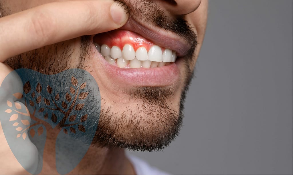 laser-gum-surgery Laser gum surgery may be your best option.
