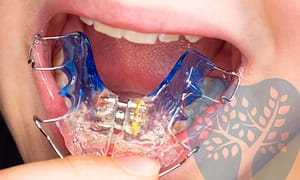 Benefits of orthodontic expanders.