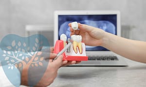 Choose dental implants if you're missing a tooth.