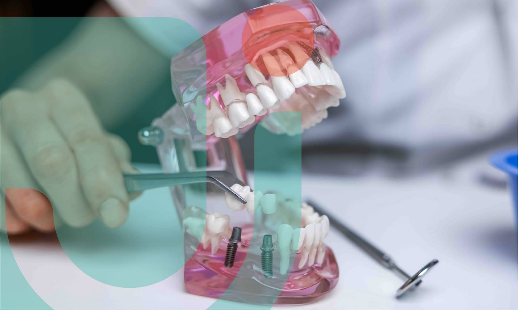 Get to know dental implants.