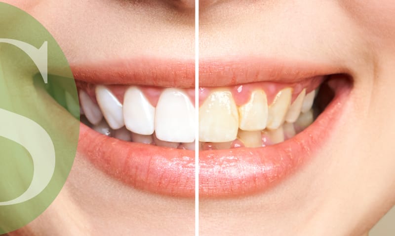 Say goodbye to yellow teeth.