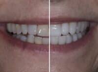 crowns veneers before and after