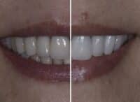 crowns before and after