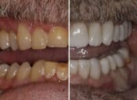 crowns veneers before and after