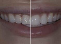 veneers before and after