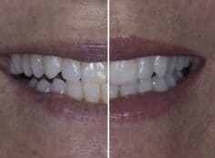 veneers before and after