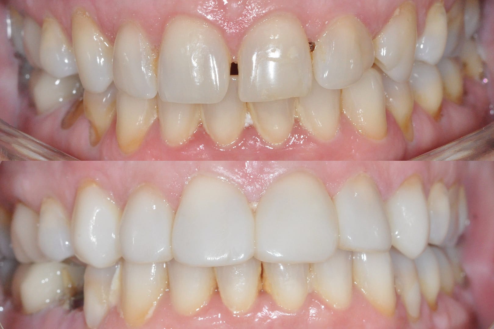 Before and After Bioclear