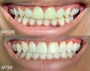Laser Gum Contouring Before and After