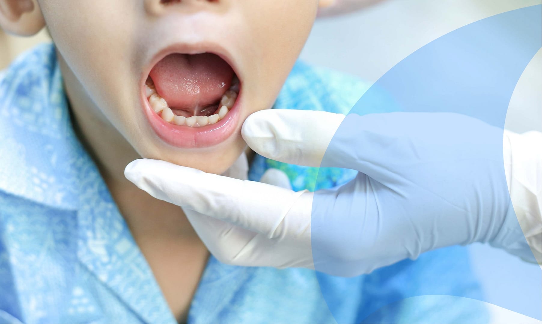 Lip and tongue tie care.
