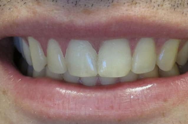 invisalign-case1-after