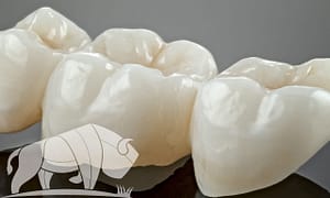 Dental bridges save smiles.