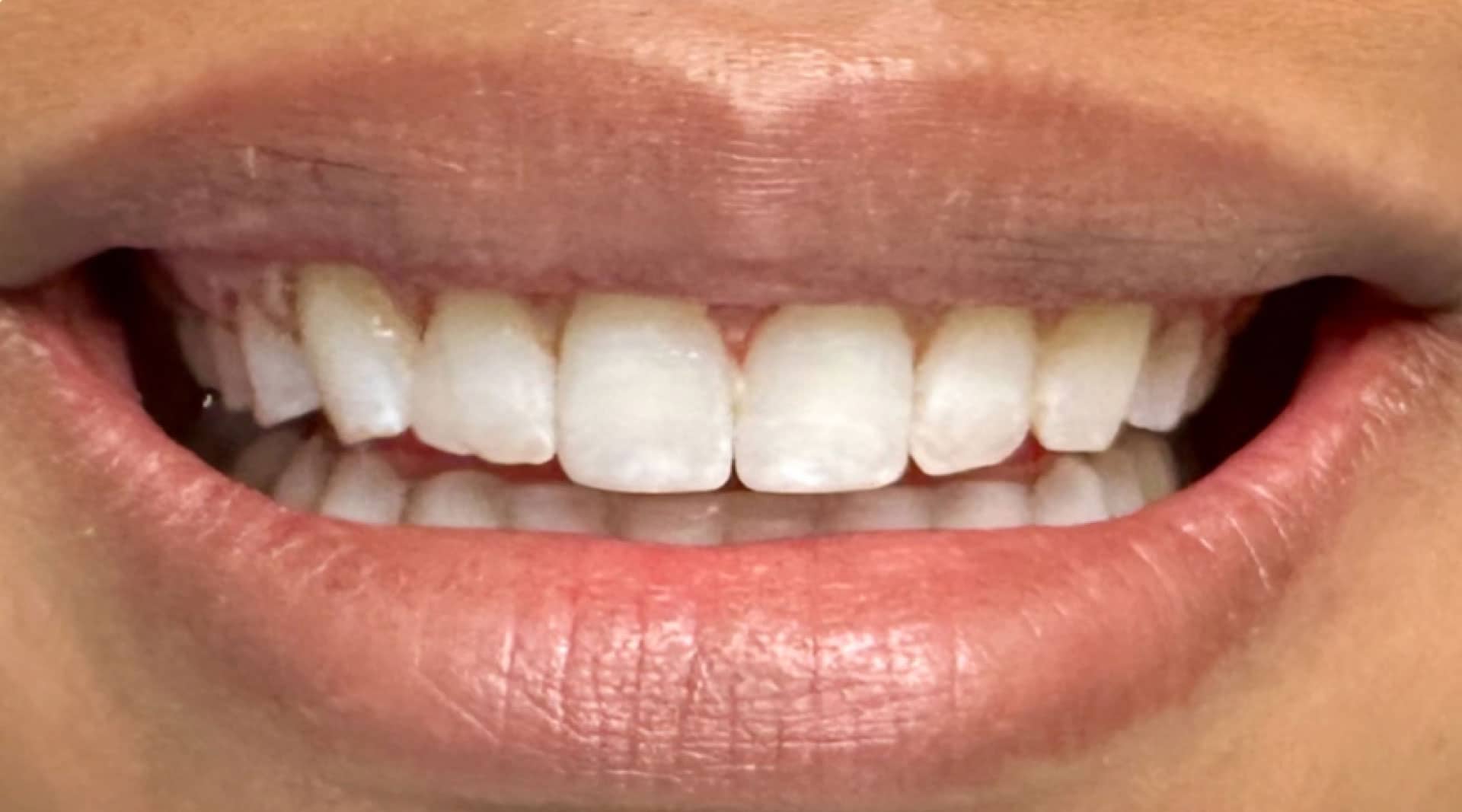 actual patient laser contour after
