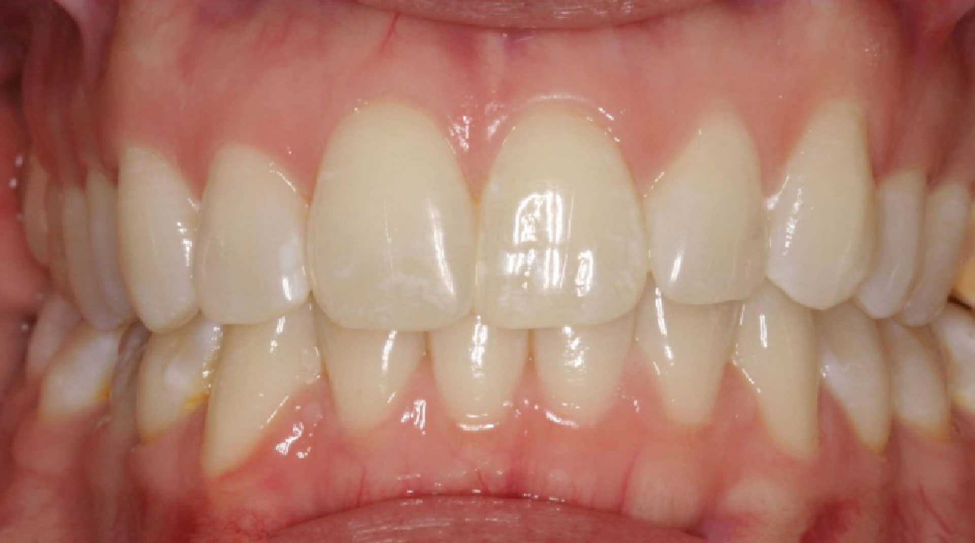 Invisalign After