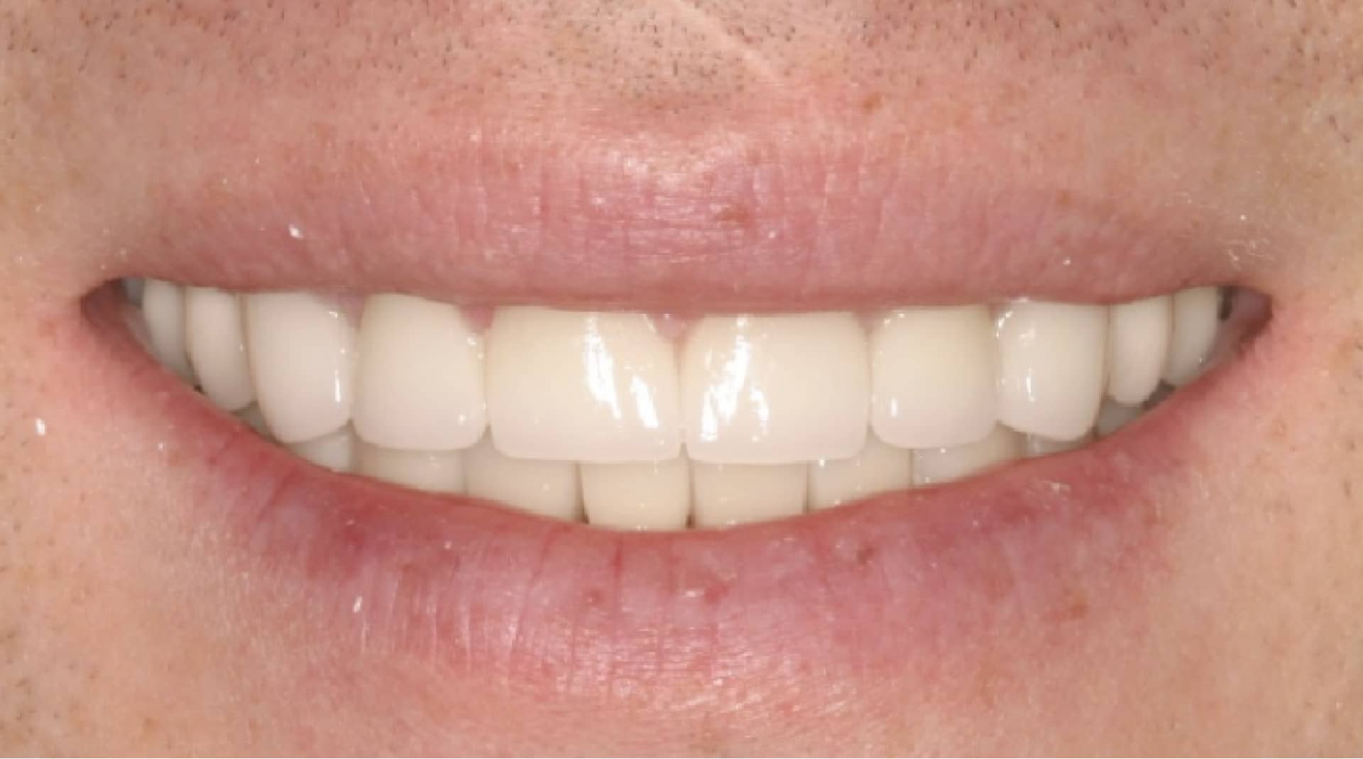 actual patient after bite correction