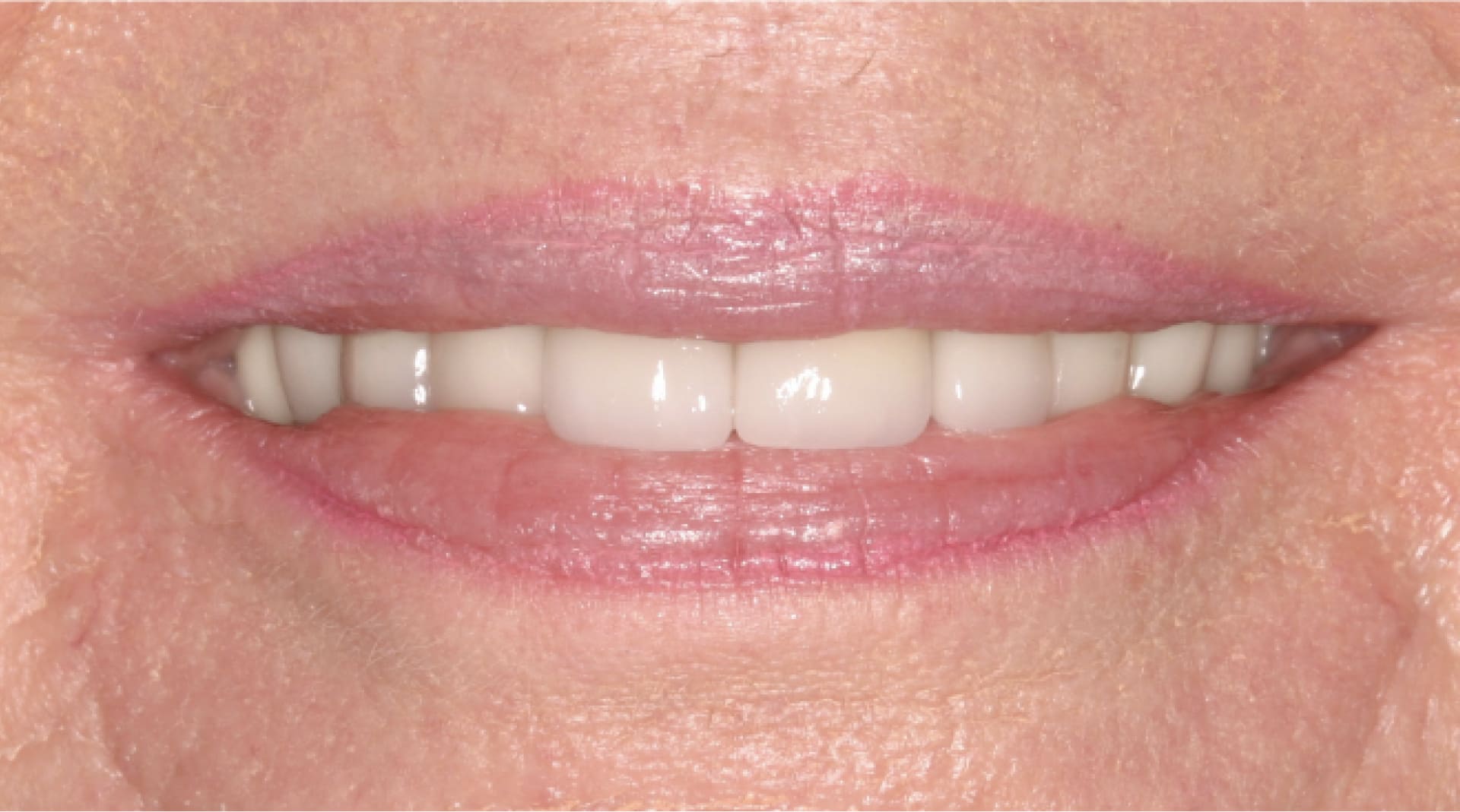 actual patient after dental bridges