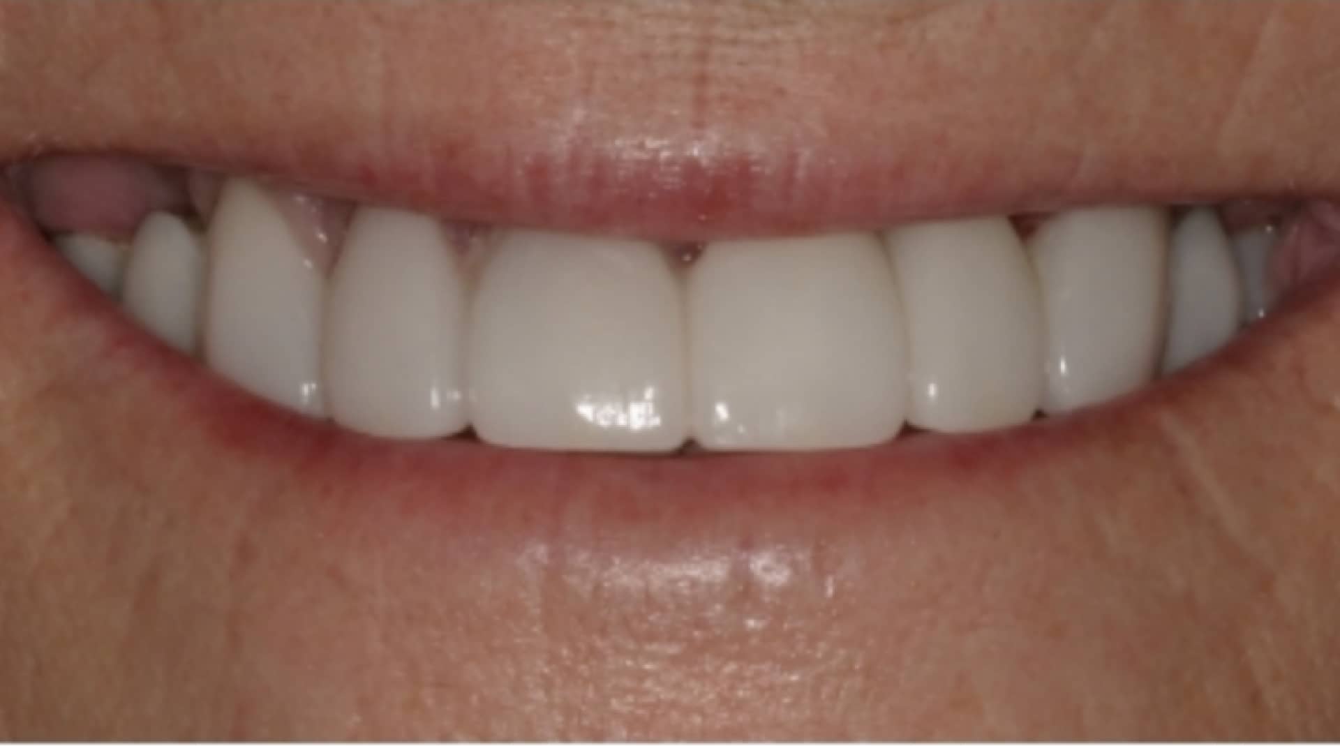actual patient after dental crowns