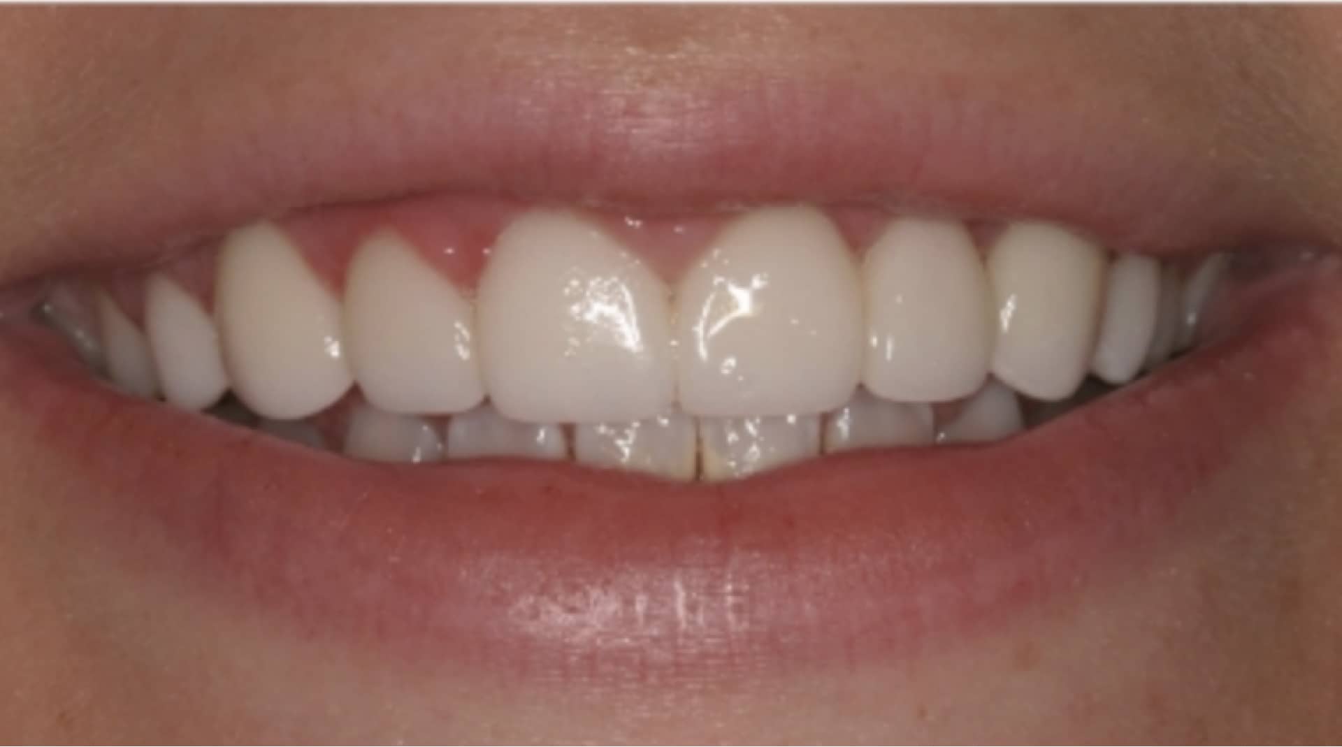 actual patient after veneers