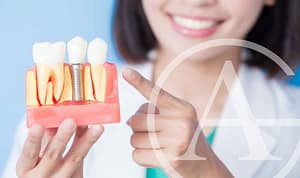 Dental implants are an eco-friendly choice.