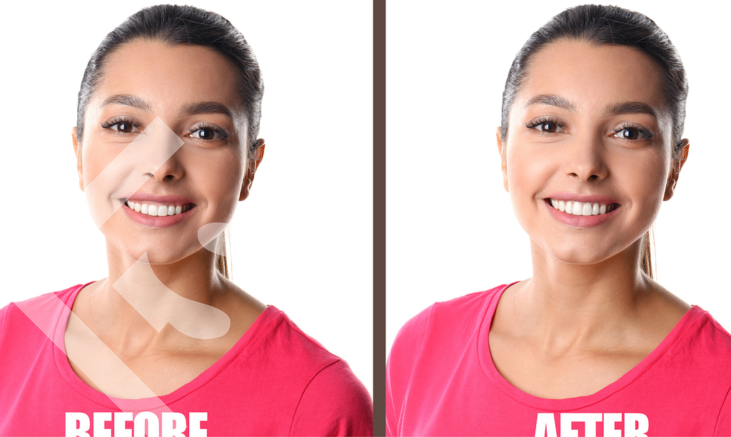 Get a perfect smile with gum contouring.