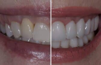 full mouth rehab before and after
