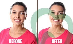 Smile symmetry with gum contouring.