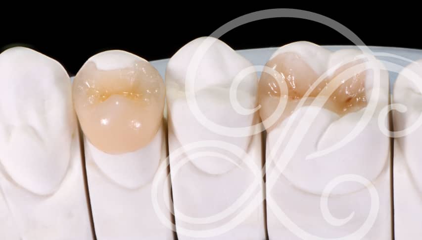 Inlays and onlays for tooth restoration.