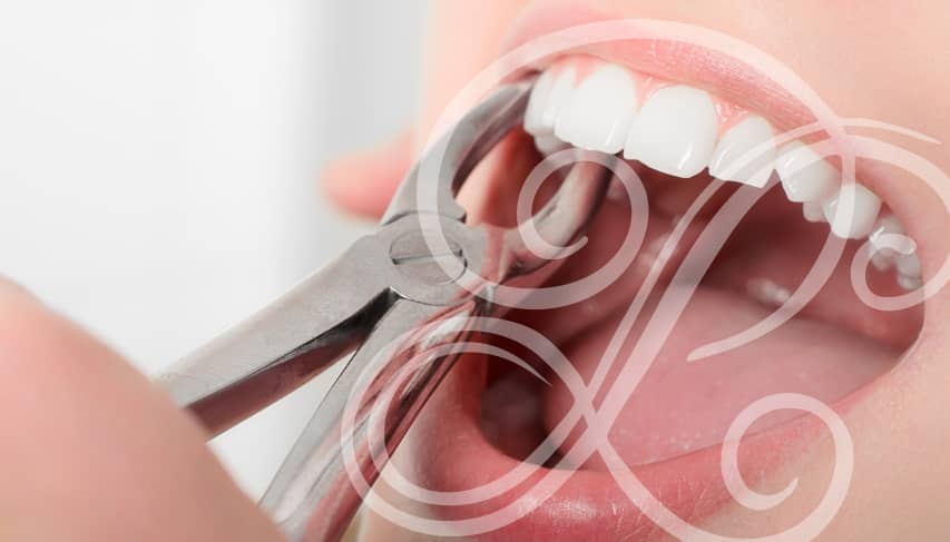 Understanding tooth extraction.