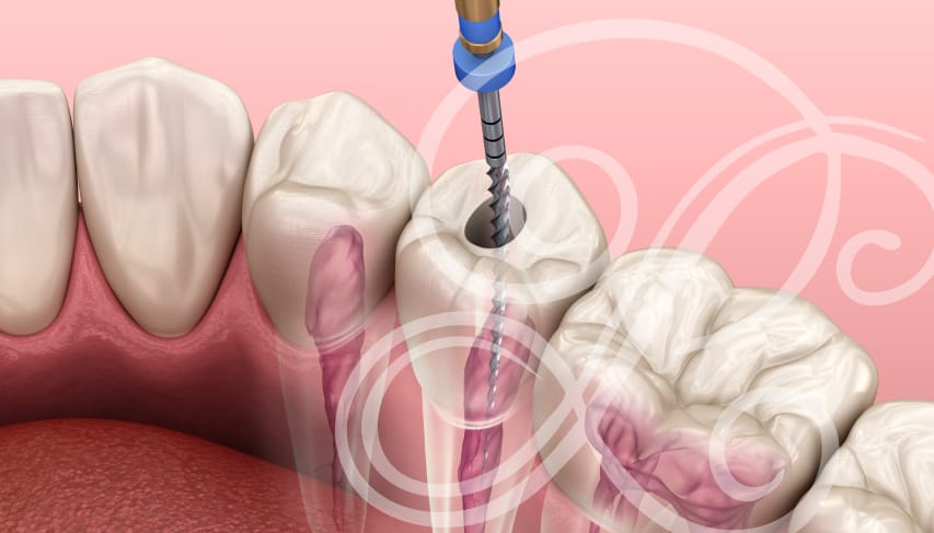 Don't believe the root canal therapy myths.