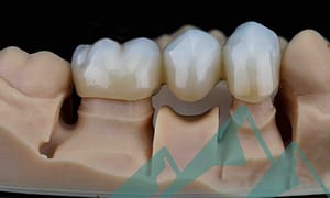 Understanding dental bridges.