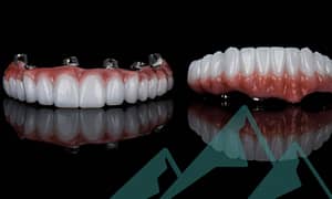 Implant-supported dentures replace missing teeth.