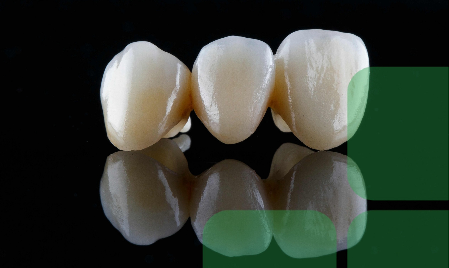 What Is a Dental Bridge? Do I Need One for My Smile?