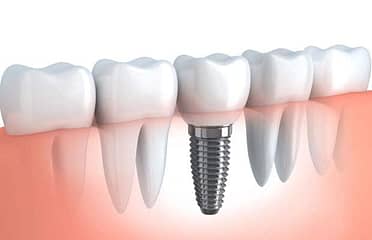 How to care for new Dental Implants