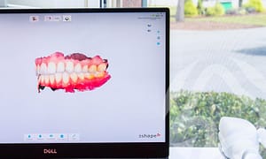 You'll love digital dental impressions