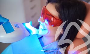 Professional tooth whitening
