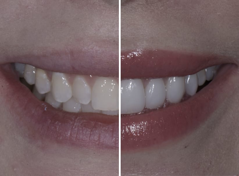 Minimal Prep Veneers Near Me at Michelle Harrell blog