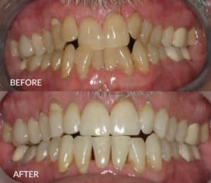 Mark Before and After