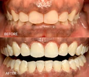 Gum Contouring Before and After