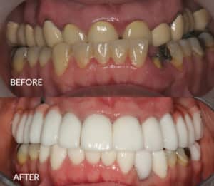 Full Mouth Restoration Before and After
