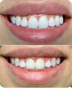 Before and After