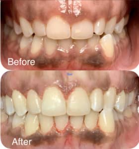 Before and After